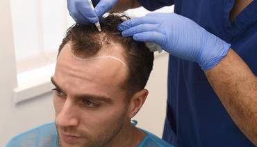 Hair Transplant