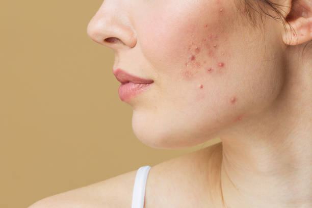 Acne Scars and Pimples