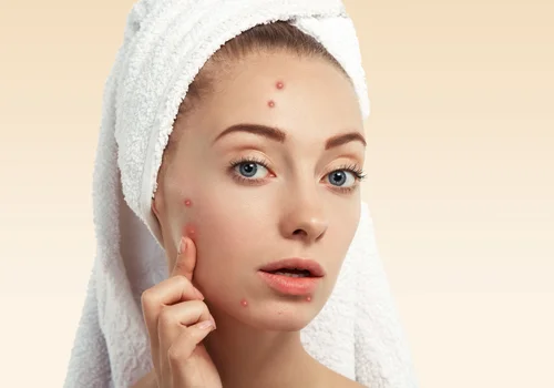 Acne Scars and Pimples